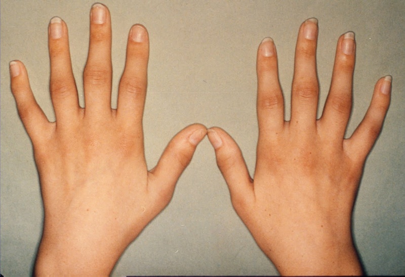 soins-dentaires-marrakech-Polyarthrite rhumatoïde