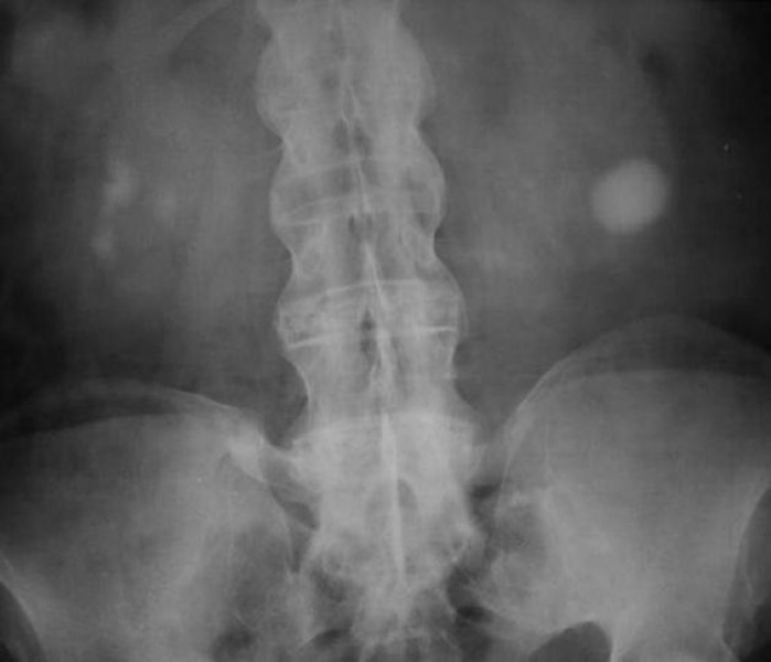 soins-dentaires-marrakech-Spondyloarthrite